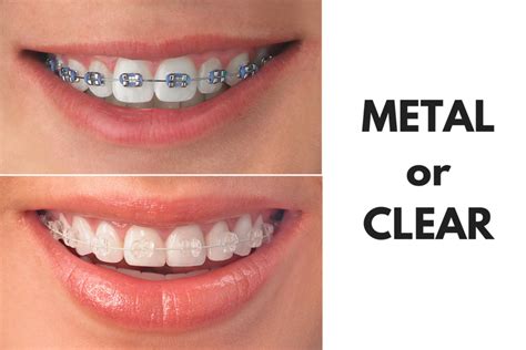 ortho metal brackets|metal braces with clear bands.